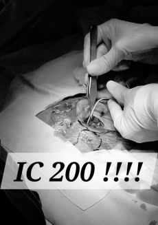 Cirugía de Implante Coclear. -